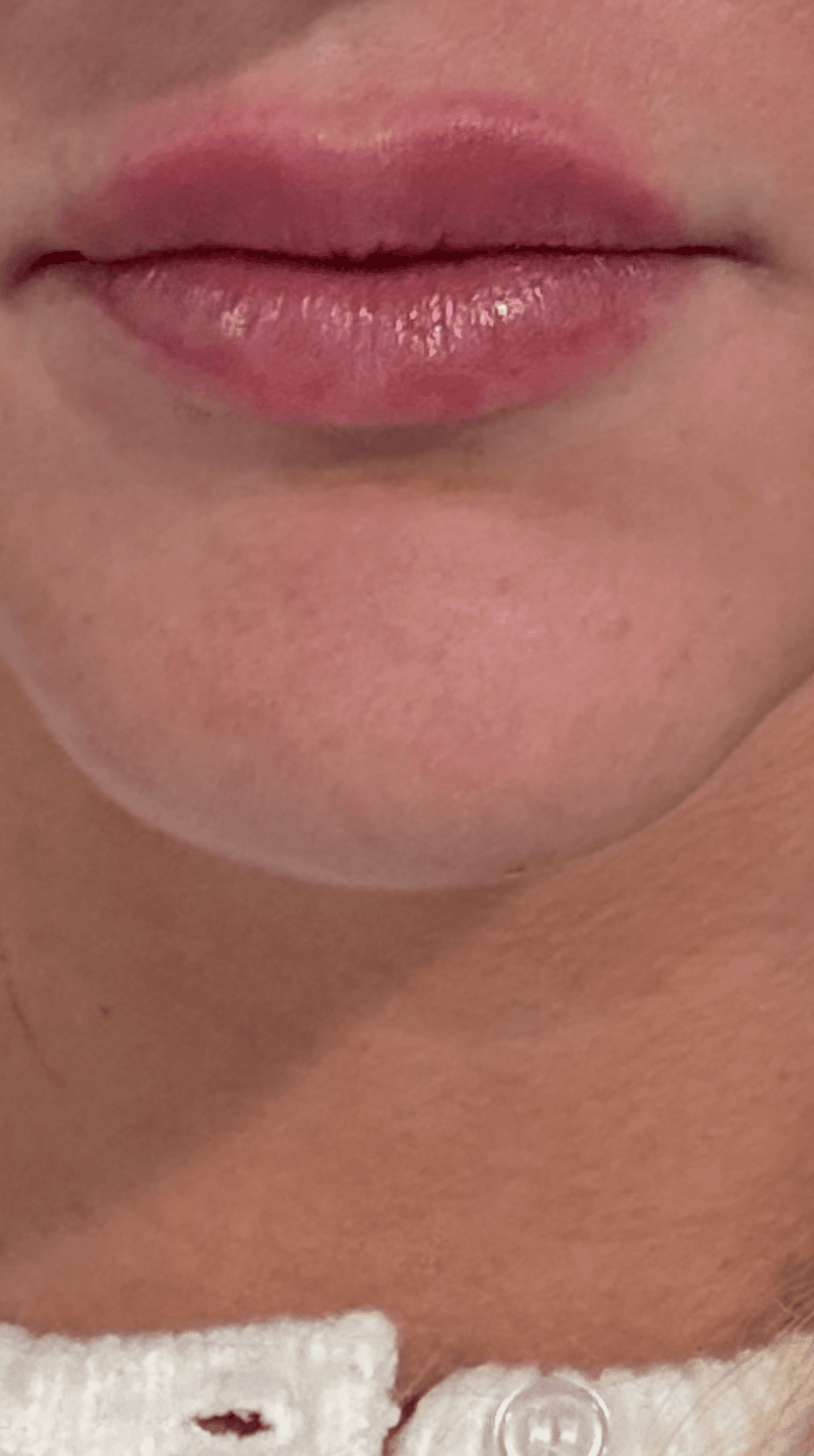 Lip Filler - After
